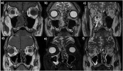 Whole exome sequencing of human papillomavirus-related multiphenotypic sinonasal carcinoma: a case report